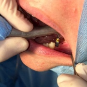 Periodoncia, Implantología y Rehabilitación Oral (PIRO)