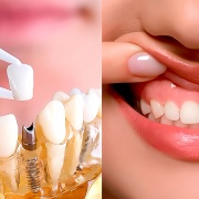 Periodoncia, Implantología y Rehabilitación Oral (PIRO)